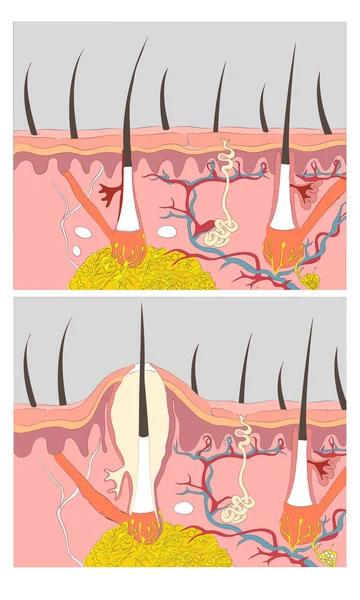 Cilt akne veya sivilce oluşumu. Tıkanmış gözenek sebum 