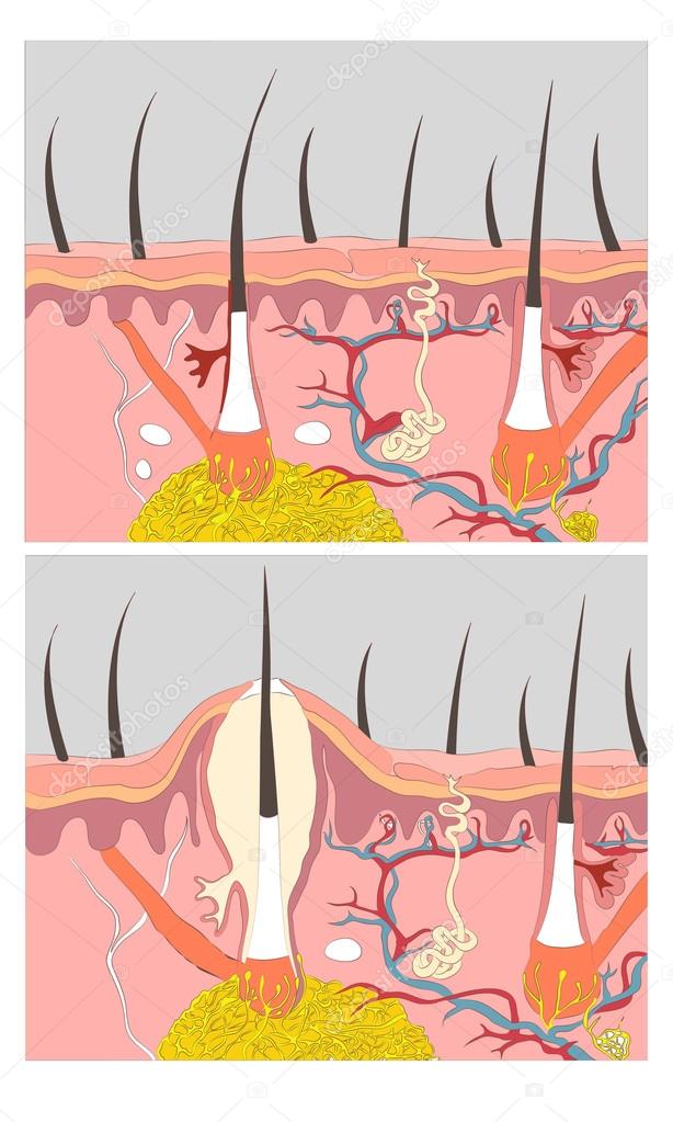 Formation of skin acne or pimple. The sebum in the clogged pore 