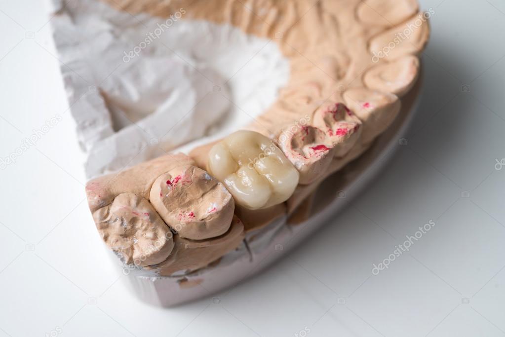 ceramic crowns in dental laboratory on white