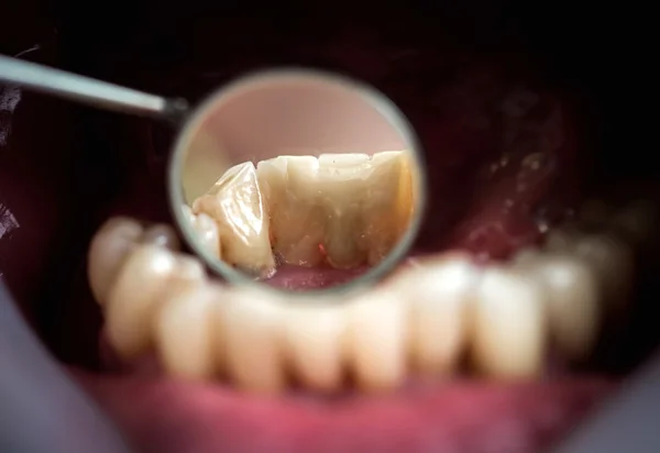 コンポジットレジンの一時的な治療の患者は歯科医からバフ歯と離れて歩くときの場合に使用するためのクラウン。これらは aestetics に以下の点で、歯の保護役割を持っています。. — ストック写真