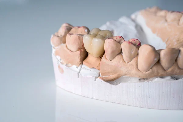 ceramic crowns in dental laboratory on white