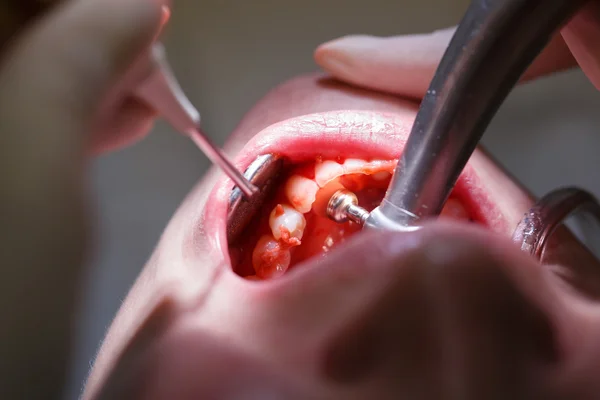 Patient på dentala tandhygienister office — Stockfoto