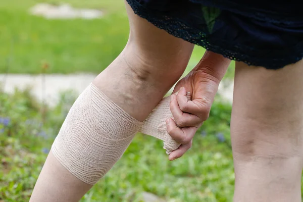 Kvinna med åderbråck tillämpa komprimering bandage — Stockfoto