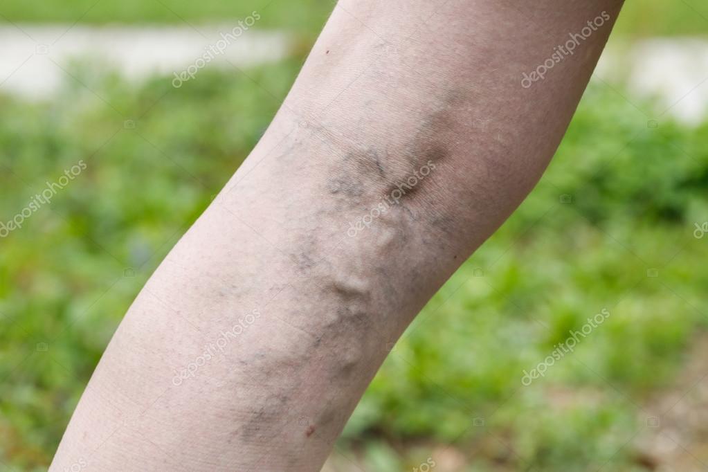 Phlebitis - Pictures, Symptoms, Treatment and Phlebitis - Pictures, Symptoms, Treatment and