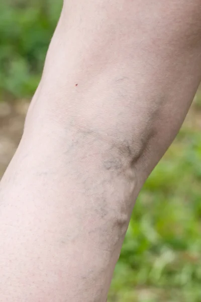 Femme avec varices douloureuses et veines d'araignée sur ses jambes — Photo