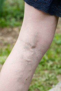 Kadın bacaklarını acı varis ve örümcek damarlar ile