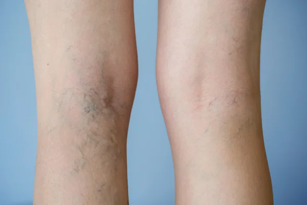 Varicose veins — Stock Photo, Image