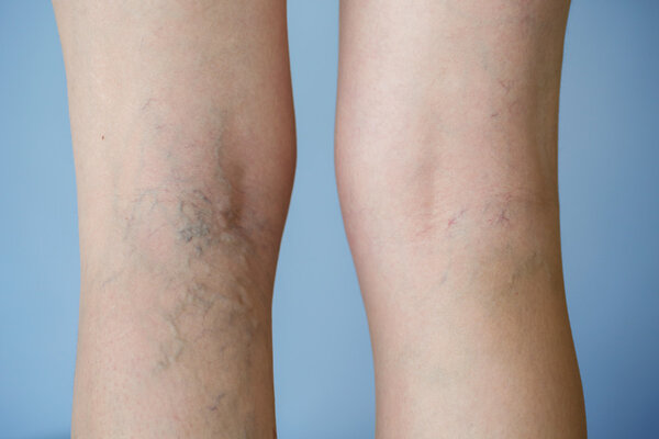 Varicose veins