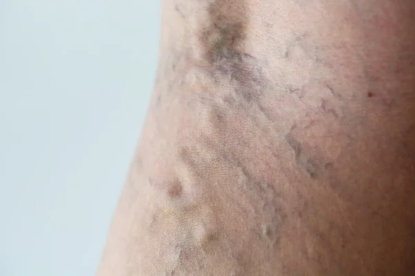 Varicose veins close-up — Stock Photo, Image