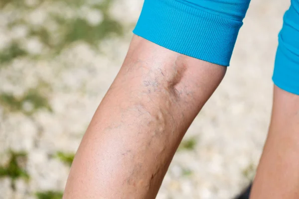 Varicose veins — Stock Photo, Image