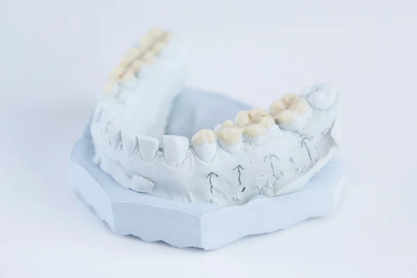 Ceramic crowns on a mold — Stock Photo, Image