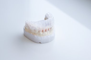 Invisalign, görünmez plastik diş aligner