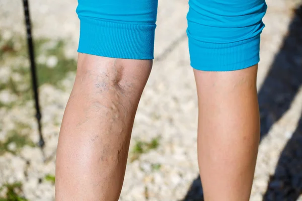 Varicose veins — Stock Photo, Image