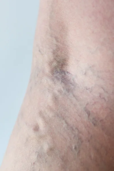 Varicose veins close-up — Stock Photo, Image