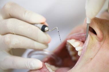 Cep derinlikleri ölçme periodontal sonda 