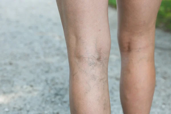 Pijnlijke spataderen en spider aderen op de benen van de dames — Stockfoto
