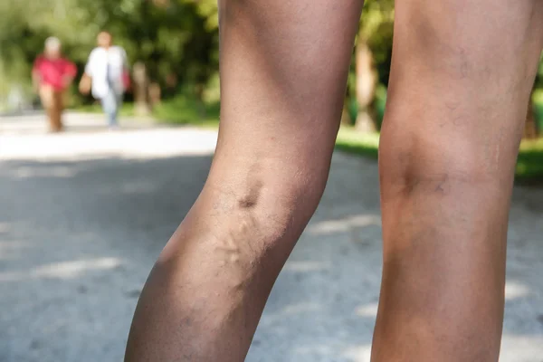 Varicosa dolorosa e veias de aranha em pernas de mulher — Fotografia de Stock