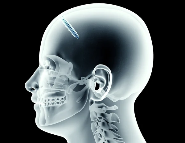 Immagine a raggi X di un cranio con una vite — Foto Stock