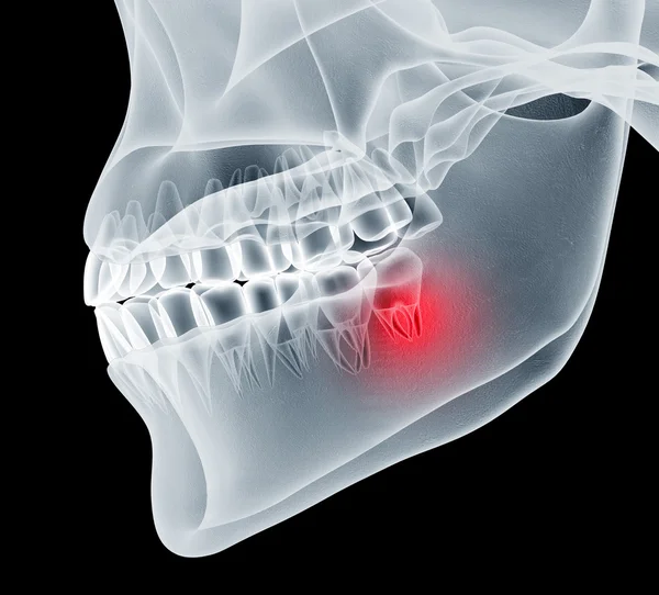 Εικόνα ακτινογραφία των ένα σαγόνι με δόντια — Φωτογραφία Αρχείου
