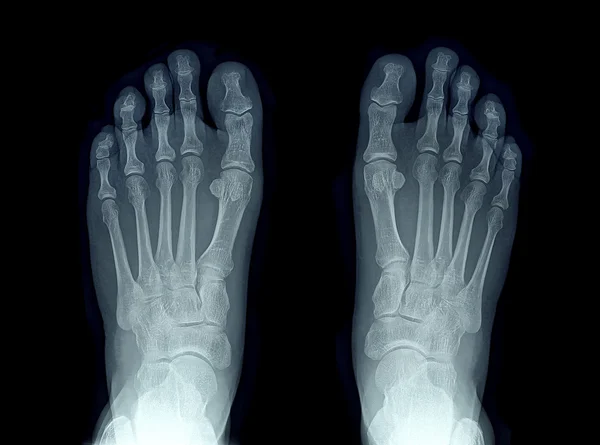 两只脚的 x 射线图像 — 图库照片