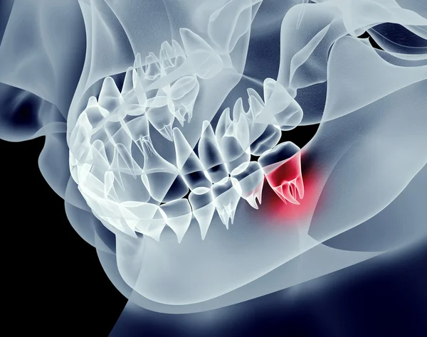 bir çene dişleri olan x-ray görüntüsü