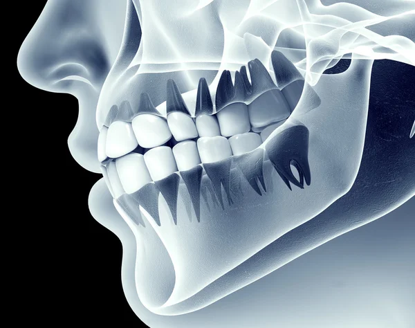 Imagen de rayos X de una mandíbula con dientes —  Fotos de Stock