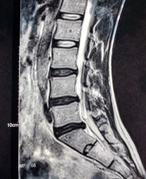 X-ray of a back with L5-S1 Lumbar Disc Herniaton