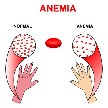 Anemi 'nin bilgi görüntüsü. Kırmızı kan hücresi sayısı ile normal anemi sayısı arasındaki fark. Kırmızı kan hücrelerinin gerçekçi vektör görüntüsü veya insan kanında hemoglobin miktarı. Tıbbi