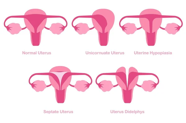 Congenitale Mulleriaanse Anomalieën Baarmoederafwijkingen Concept Illustratie Vrouwelijke Voortplantingsconditie — Stockvector