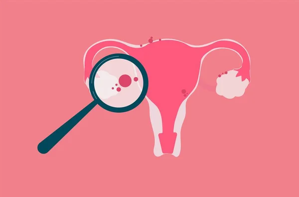Endometriosis Concept Illustration Medical Content Educational Purpose — Stock Vector