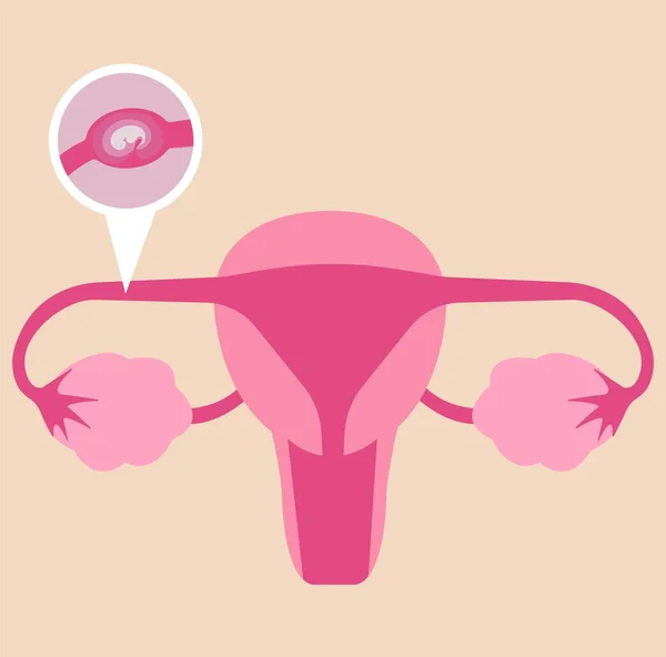 Embarazo Ectópico Embarazo Con Trompas Falopio — Archivo Imágenes Vectoriales