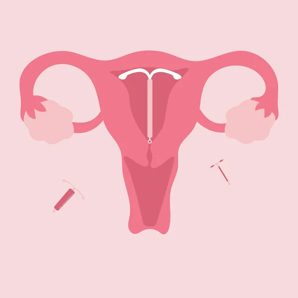Illustration Plate Contraception Diu — Image vectorielle