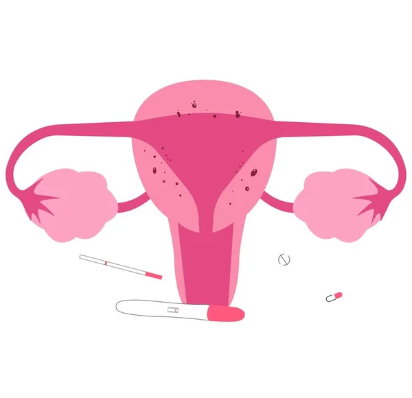 Adenomyose Een Van Medische Aandoening Van Vrouwelijke Voortplanting Orgaan Onvruchtbaarheid — Stockvector