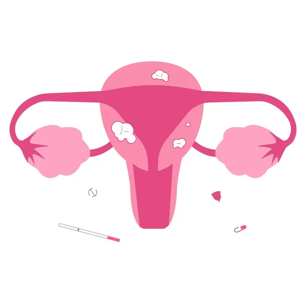 Fibrome Utérin Problèmes Organes Reproducteurs Féminins Causes Infertilité — Image vectorielle