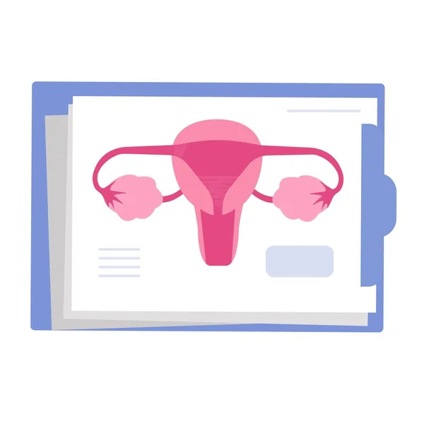 Uterusverklebungen Ashermans Sydnromisches Symptom Weibliche Unfruchtbarkeit — Stockvektor