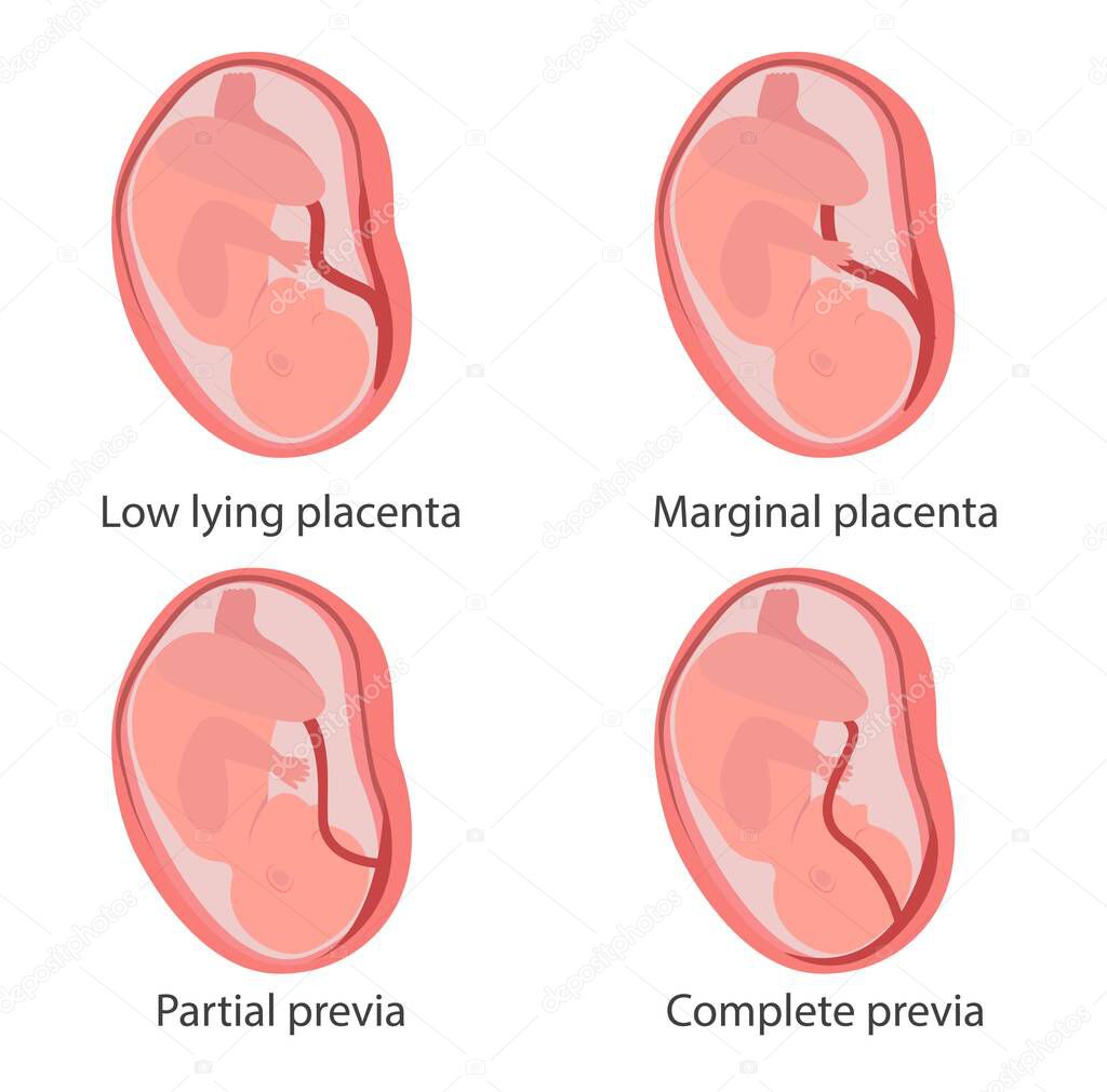 Four types of placenta previa concept illustration