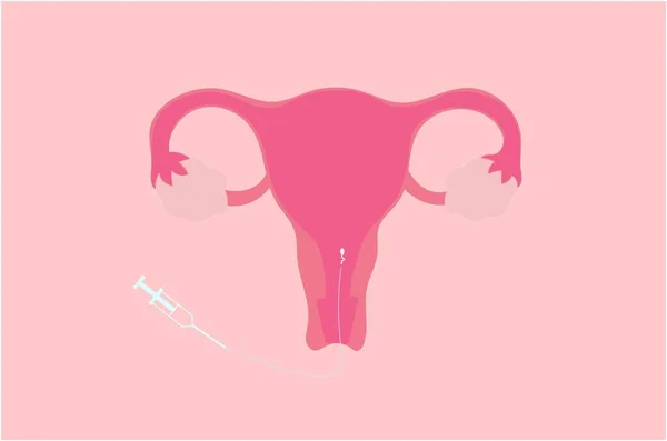 Illustrazione Vettoriale Dell Inseminazione Intrauterina Iui — Vettoriale Stock