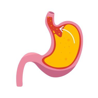 GERD veya gastroözofajiyal reflü hastalığı