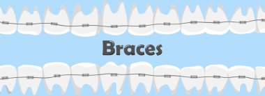 Diş telli insan dişleri. diş sağlığı konsepti.