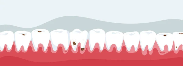 Čelist Zuby Caries Sekci — Stock fotografie