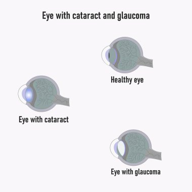 Glaukoma gözü. Glaucoma 'nın gelişimi. Gözün yapısı. Katarakt. Göz görme bozukluğu. Göz diyagramı. Glokom ve katarakt belirtileri. Dünya glokom günü. T