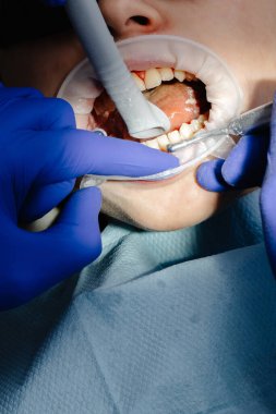 Muayene sırasında diş temizleme aletleri kullanan dişçi elleri, koruyucu gözlük takan hasta.