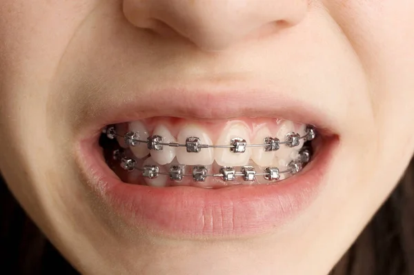 Orthodontic treatment. Dental care concept. Smiling teenage girl with braces.