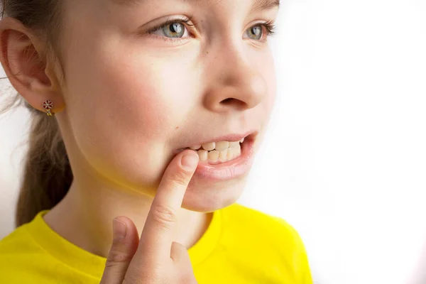 Liten flicka står på en vit bakgrund med ett vackert leende, barn krokiga tänder, pediatrisk tandvård. Krokiga tänder närbild. Korrigering av malocklusion krävs. — Stockfoto