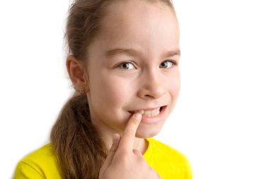 Küçük kız güzel bir gülümsemeyle beyaz bir arka planda duruyor, çocuklar çarpık dişler, pediatrik dişçilik. Çarpık dişler, yakın plan. Maloklasyonun düzeltilmesi gereklidir.