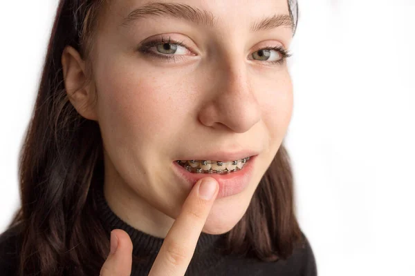 Fogszabályzó kezelés. Fogápolási koncepció. Mosolygó tinilány fogszabályzóval. Fémfogszabályzó közelkép a fogakról. — Stock Fotó