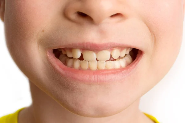 Menina fica em um fundo branco com um belo sorriso, crianças dentes tortos, odontologia pediátrica. Dentes tortos de perto. É necessária a correção da má oclusão. — Fotografia de Stock