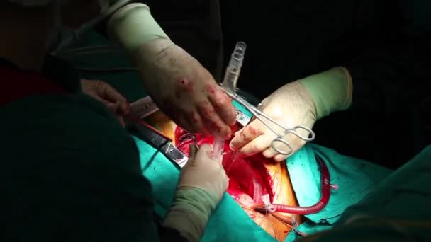 Scene of an operation, surgical series 29 HD 1080p — Stock Video