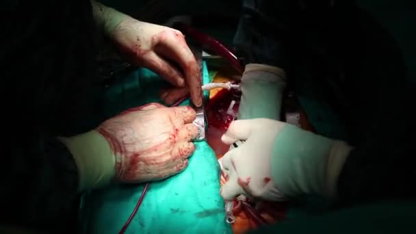 Scene of an operation, surgical series 25 HD 1080p — Stock Video