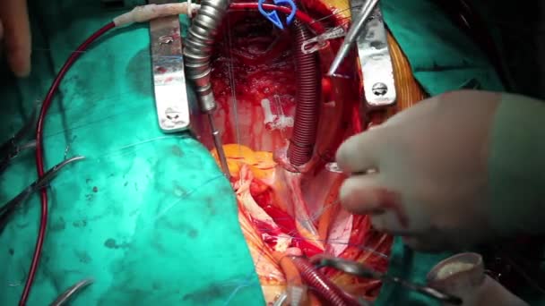 Scene of an operation, surgical series 19 HD 1080p — Stock Video